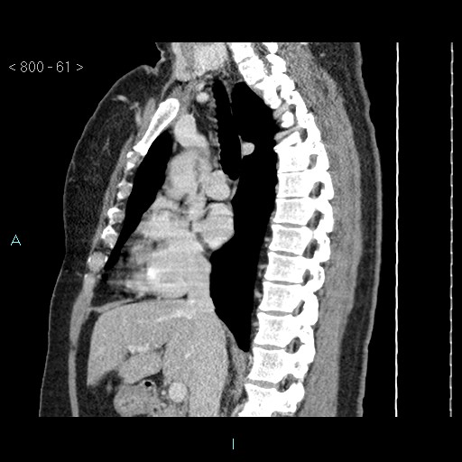 File:Bronchogenic cyst - posterior mediastinal (Radiopaedia 43885-47364 B 40).jpg
