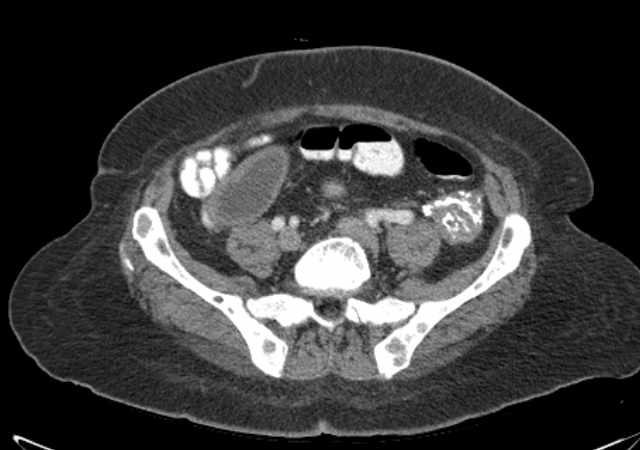 Brown tumors compressing the spinal cord (Radiopaedia 68442-77988 E 89).jpg