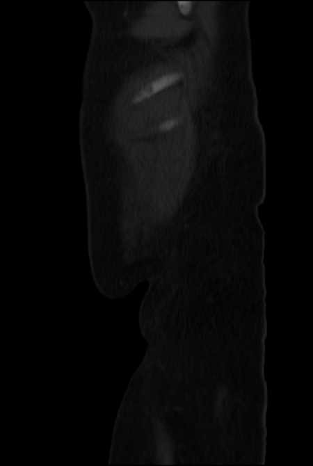 Brown tumors compressing the spinal cord (Radiopaedia 68442-77988 H 55).jpg