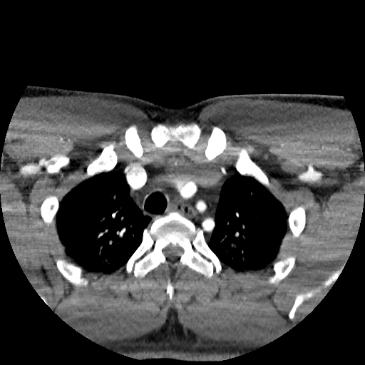 Buccal fat pad arteriovenous malformation (Radiopaedia 70936-81144 D 12).jpg