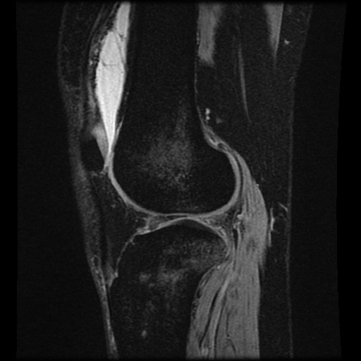Bucket handle meniscus tear (Radiopaedia 56916-63751 H 26).jpg