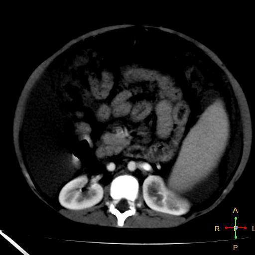 File:Budd-Chiari syndrome (Radiopaedia 23072-23103 C+ arterial phase 14).jpg