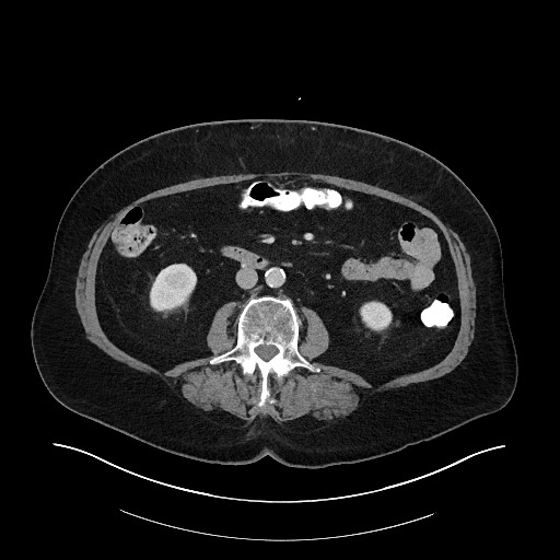 Buried bumper syndrome - gastrostomy tube (Radiopaedia 63843-72575 A 44).jpg