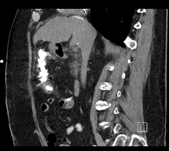 Buried bumper syndrome - gastrostomy tube (Radiopaedia 63843-72577 Sagittal Inject 72).jpg