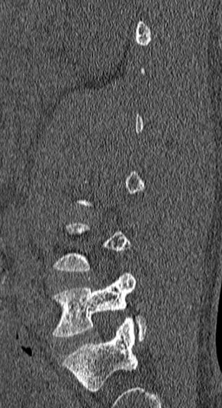 Burst fracture (Radiopaedia 53373-59357 Sagittal bone window 67).jpg