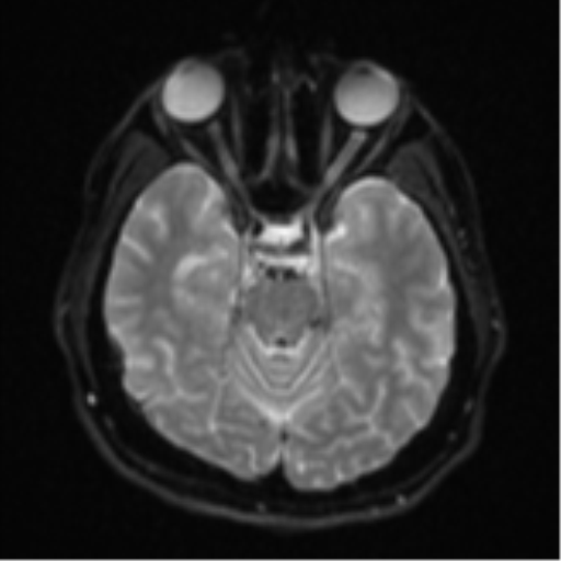 File:CNS vasculitis (Radiopaedia 55715-62263 Axial DWI 10).png