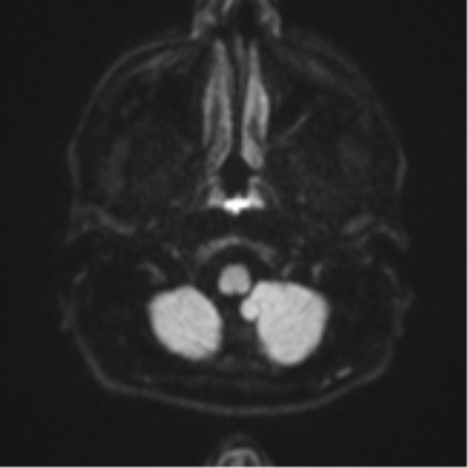 File:CNS vasculitis (Radiopaedia 55715-62263 Axial DWI 32).png