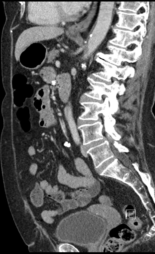 Calcified adrenal glands and Spigelian hernia (Radiopaedia 49741-54988 C 76).jpg