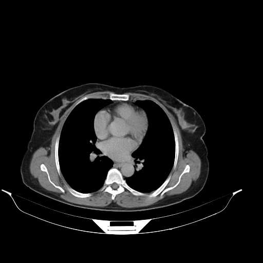 File:Calcified hydatid cyst of the liver (Radiopaedia 21212-21112 Axial C+ delayed 2).jpg