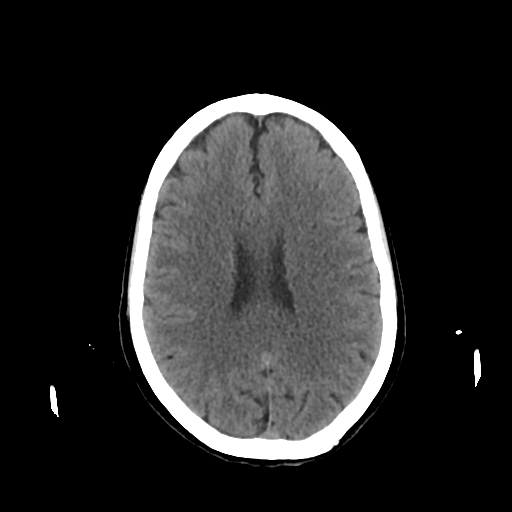 File:Calcified meningioma - cervical canal (Radiopaedia 70136-80171 Axial non-contrast 17).jpg
