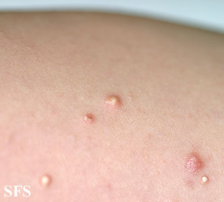 Calcinosis Cutis (Dermatology Atlas 8).jpg
