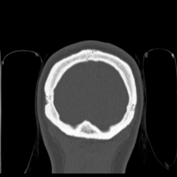 Calvarial osteoma (Radiopaedia 36520-38079 C 88).jpg