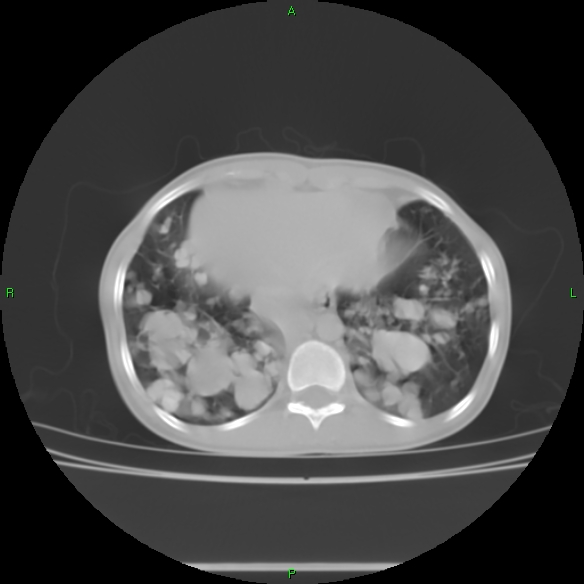 File:Cannon ball metastases - synovial sarcoma (Radiopaedia 26135-26271 Axial lung window 29).jpg