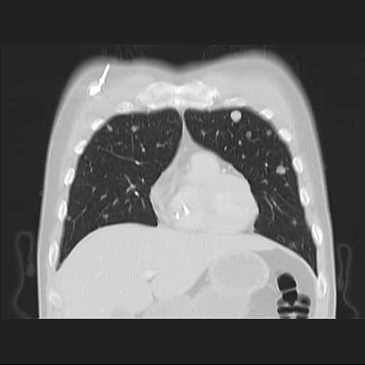 File:Cannonball pulmonary metastases (Radiopaedia 67684-77101 C 6).jpg