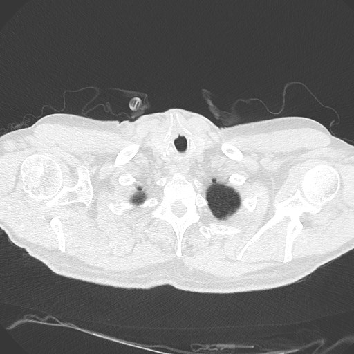Caplan syndrome (Radiopaedia 56667-63530 Axial lung window 17).jpg