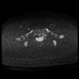 Carcinoma of the cervix (Radiopaedia 89018-105858 Axial DWI 69).jpg