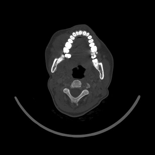 Carcinoma of the maxillary antrum (Radiopaedia 53805-59888 Axial bone window 89).jpg