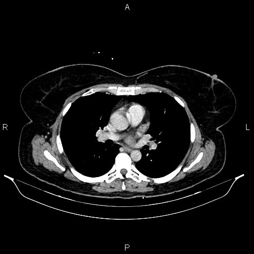 File:Carcinoma of uterine cervix (Radiopaedia 85861-101700 A 19).jpg