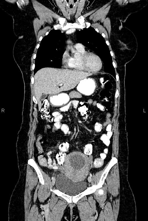Carcinoma of uterine cervix (Radiopaedia 85861-101700 C 16).jpg