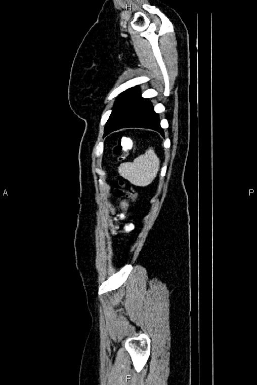 Carcinoma of uterine cervix (Radiopaedia 85861-101700 D 81).jpg