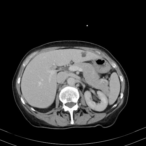 Carcinosarcoma (Radiopaedia 70401-80503 A 20).jpg
