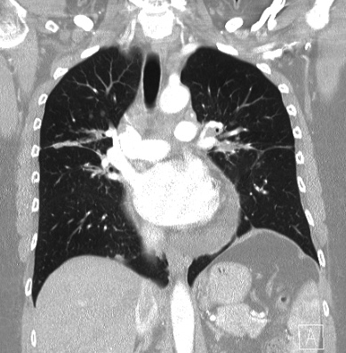 Cardiac sarcoidosis (Radiopaedia 74548-85534 Coronal lung window 34).jpg