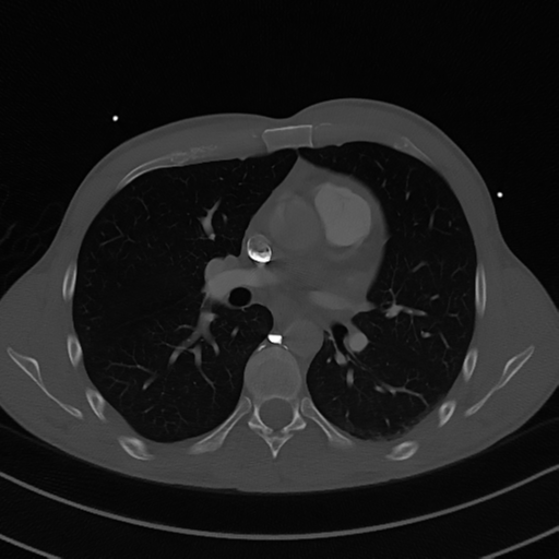 Cardiac tumor - undifferentiated pleomorphic sarcoma (Radiopaedia 45844-50134 Axial bone window 33).png