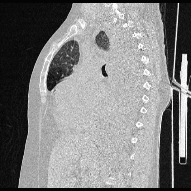 Cardiogenic pulmonary edema (Radiopaedia 29213-29609 Sagittal lung window 43).jpg