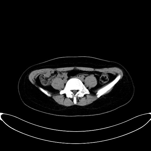 Caroli disease with medullary sponge kidney (Radiopaedia 82622-96804 Axial non-contrast 50).jpg