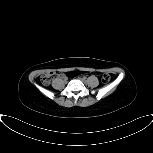 Caroli disease with medullary sponge kidney (Radiopaedia 82622-96804 Axial non-contrast 51).jpg