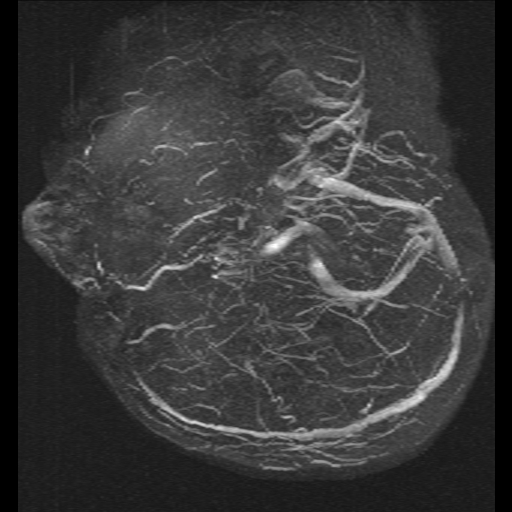 Carotid arterial dissection with acute cerebral infarction (Radiopaedia 26636-26784 MRV 17).jpg
