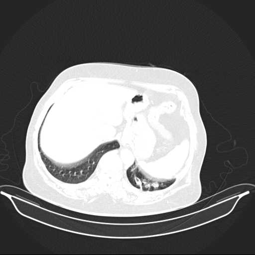 File:Carotid body tumor (Radiopaedia 21021-20948 Axial lung window 41).jpg