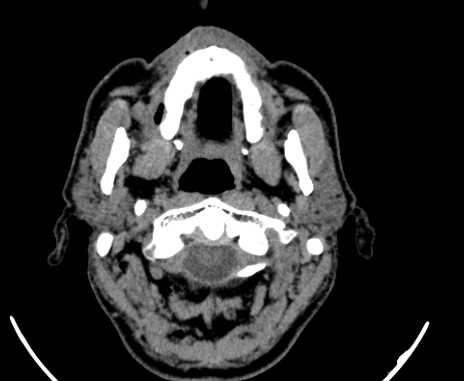 Carotid body tumor (Radiopaedia 61750-69757 Axial non-contrast 10).jpg