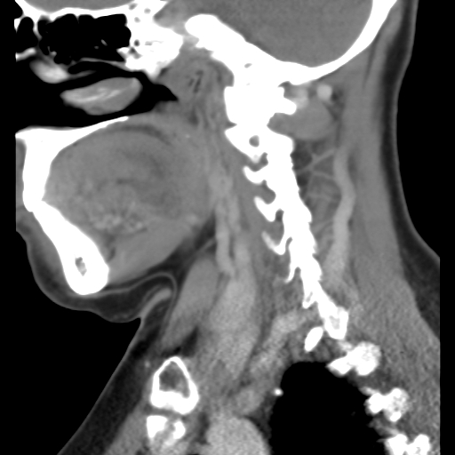 File:Carotid body tumor (paraganglioma) (Radiopaedia 38586-40729 C 13).jpg