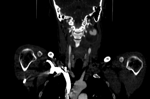 Carotid bulb pseudoaneurysm (Radiopaedia 57670-64616 D 38).jpg