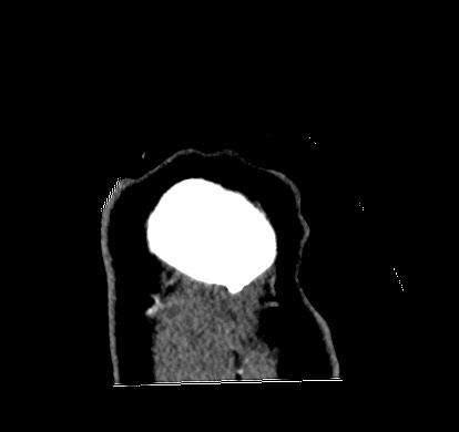 Carotid canal sympathetic schwannoma (Radiopaedia 68925-78671 Coronal venous 78).jpg