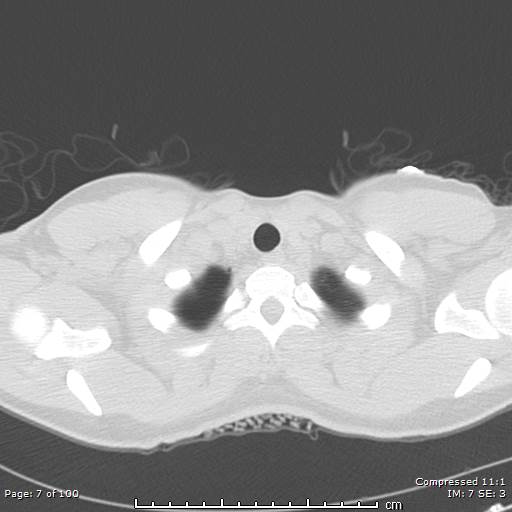 Catamenial pneumothorax (Radiopaedia 54382-60600 Axial non-contrast 7).jpg