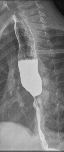 File:Caustic esophageal stricture (Radiopaedia 67290-76661 B 1).PNG