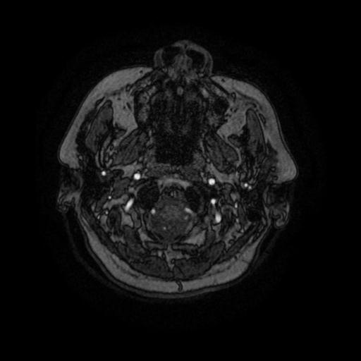 File:Cavernoma with developmental venous anomaly (Radiopaedia 22470-22507 MRA 105).jpg