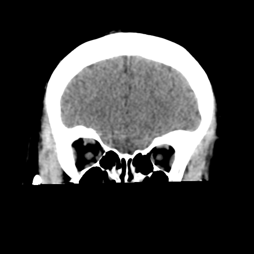 Cavernoma with hemorrhage (Radiopaedia 70755-80931 Coronal non-contrast 16).png