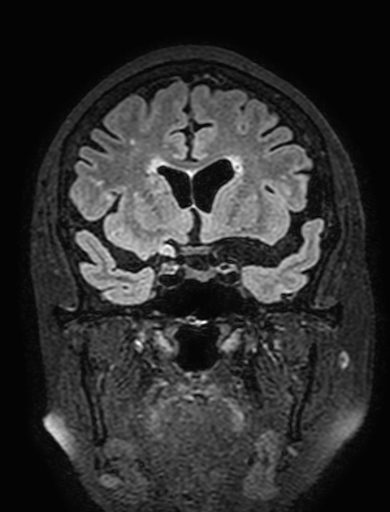 Cavernous hemangioma of the cerebellar falx (Radiopaedia 73025-83724 Coronal FLAIR 122).jpg