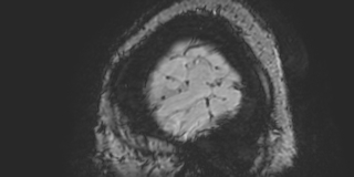 Cavernous hemangioma of the cerebellar falx (Radiopaedia 73025-83724 Sagittal BOLD 11).jpg