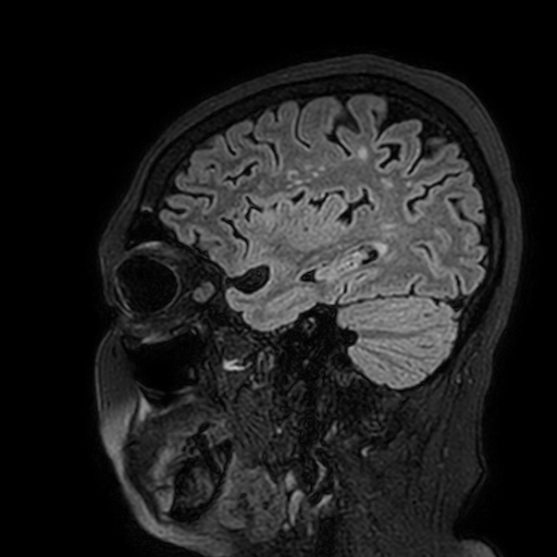 Cavernous hemangioma of the cerebellar falx (Radiopaedia 73025-83724 Sagittal FLAIR 49).jpg