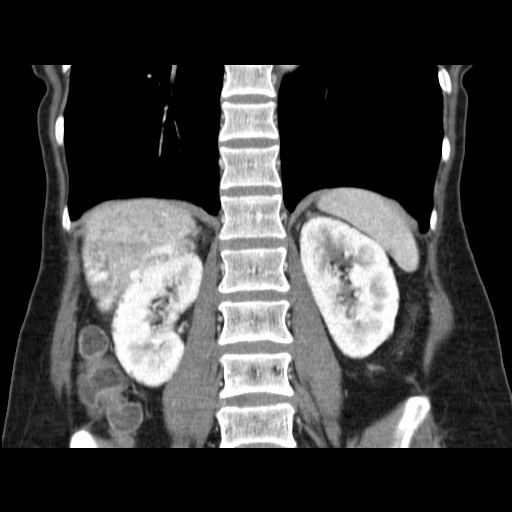 Cavernous hepatic hemangioma (Radiopaedia 75441-86667 C 100).jpg