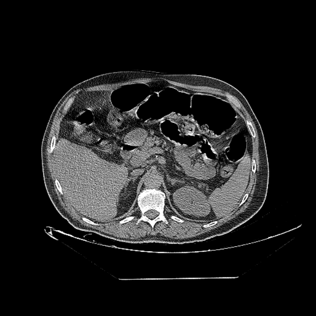 Cavitating bronchogenic carcinoma (Radiopaedia 44489-48162 Axial non-contrast 96).jpg