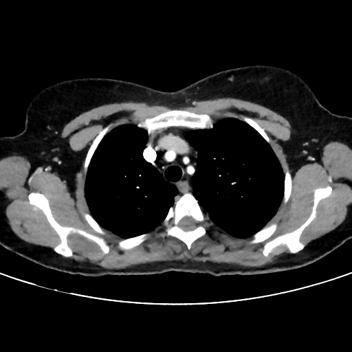 File:Cavitating lung mass - squamous cell carcinoma (Radiopaedia 48047-52854 B 12).png