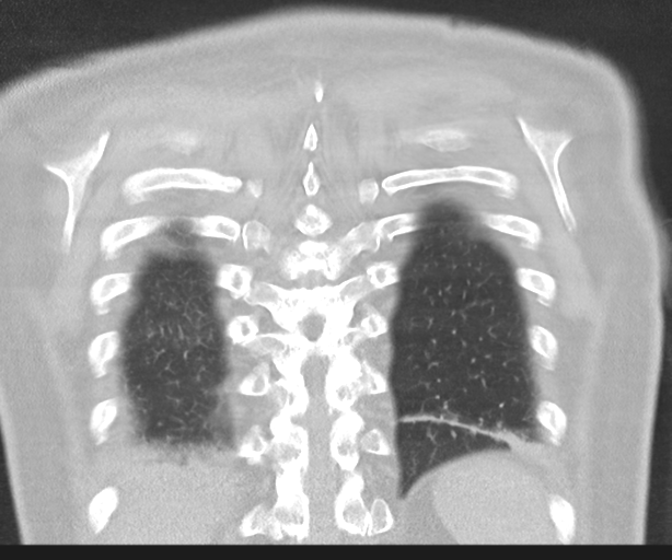 Cavitating pneumonia (Radiopaedia 45998-50329 Coronal lung window 42).png