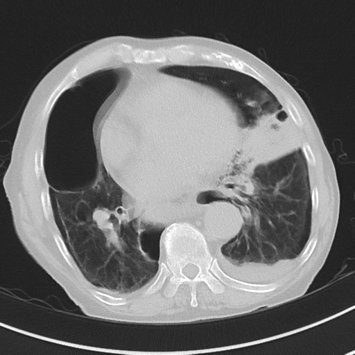 Cavitating pneumonia - lingular segments (Radiopaedia 34386-35678 Axial lung window 39).png