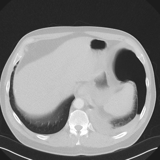 Cavitating pneumonia complicated by pneumothorax (Radiopaedia 48149-52994 Axial lung window 56).png