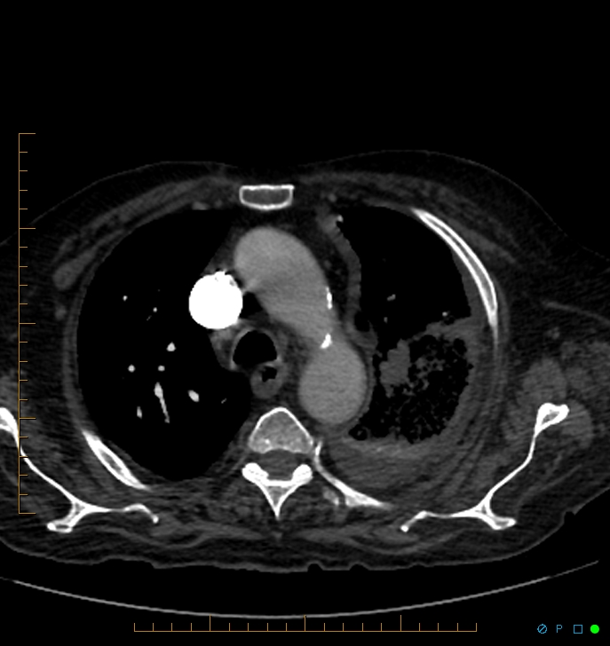 Cavitating pulmonary infarction (Radiopaedia 54634-60849 Axial C+ CTPA 15).jpg
